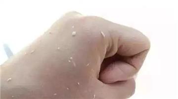 Is the skin horny skin rubbed by Rubibo? No, that is the love crystallization of Carbomer and Cousins